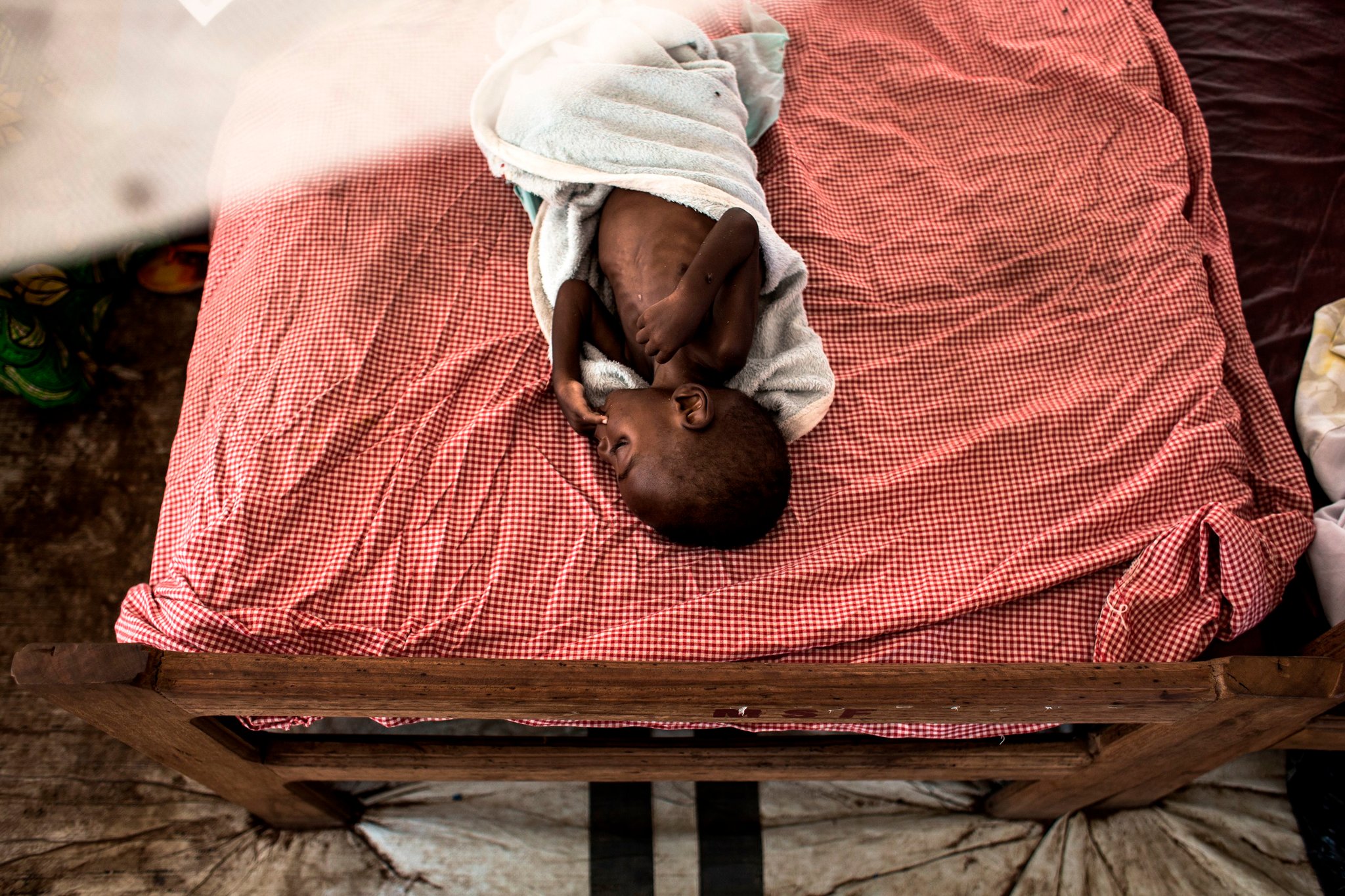A severely malnourished child at a feeding and rehabilitation centre in Tshikapa, Congo, in October. A severely malnourished child at a feeding and rehabilitation centre in Tshikapa, Congo, in October.