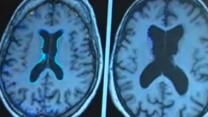 Transsexual Differences Caught On Brain Scan Sbs News