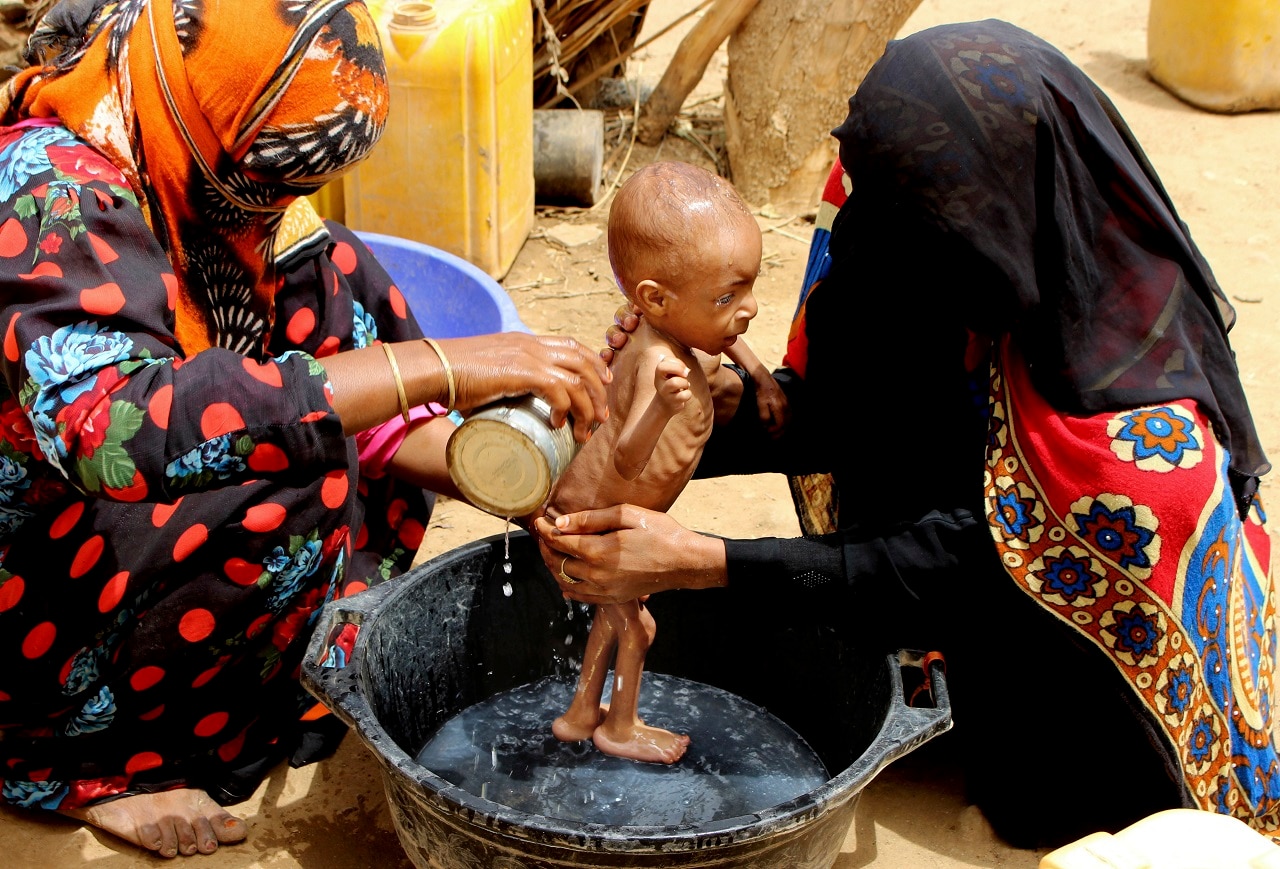A severely malnourished infant is bathed in a bucket in Aslam, Hajjah, Yemen. 