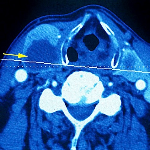Thyroid Nodule, Scan