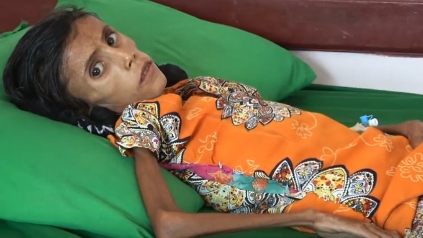 Starving Girl Shows Impact Of Yemen War Economic Collapse Sbs News 