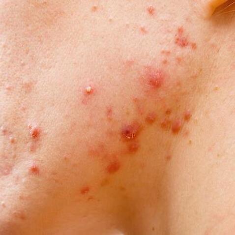 What food causes pimples?
