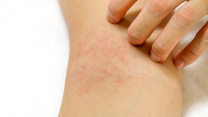 The most common skin conditions of Filipinos during the winter season are dermatitis, eczema and cold urticaria