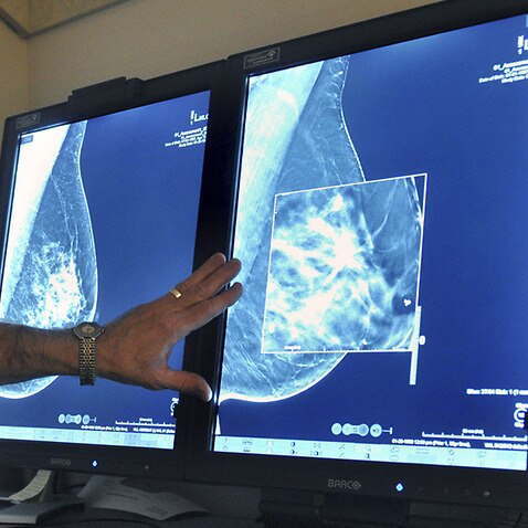 A radiologist studies a mammogram (AAP)