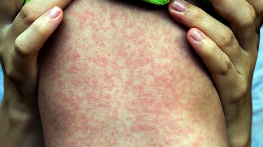 Image for read more article 'Anti-vaxxer movement fuelling global  resurgence of measles, say WHO'