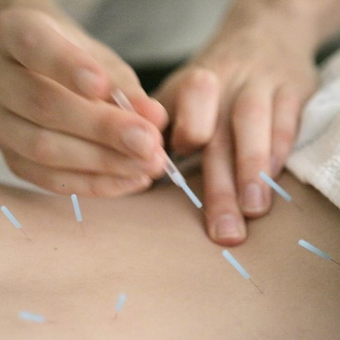acupuncture needles in the muscles around the spine