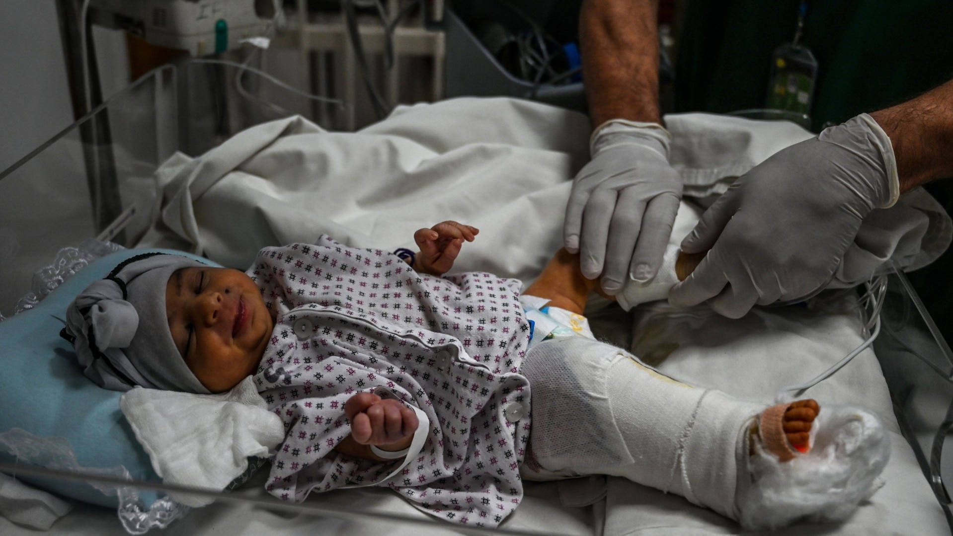 After losing her mother in the attack, newborn baby Bibi Amena, receives treatment for gun wound in her right leg as she has been rescued and brought to the French Medical Institute for Children.