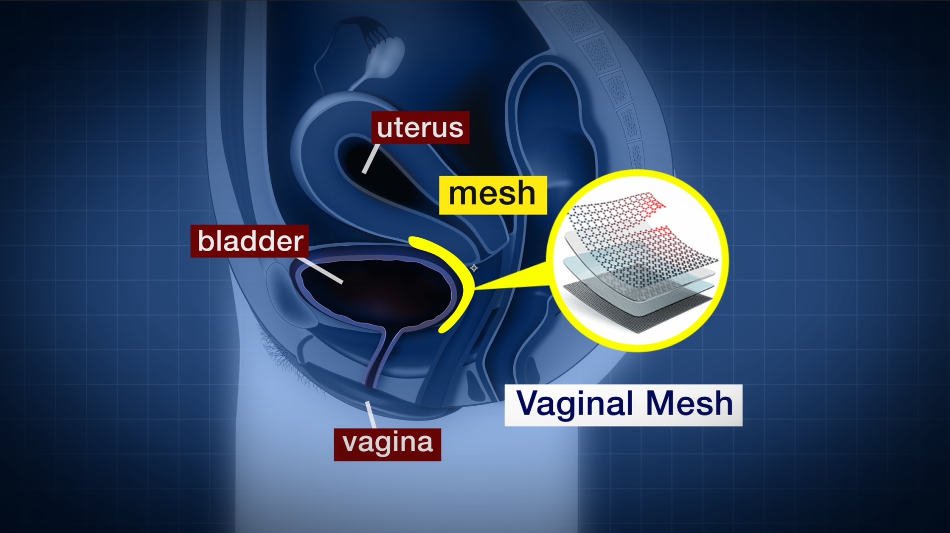Vaginal Mesh Implants Lawsuit Against Johnson And Johnson Set To Commence Sbs News 