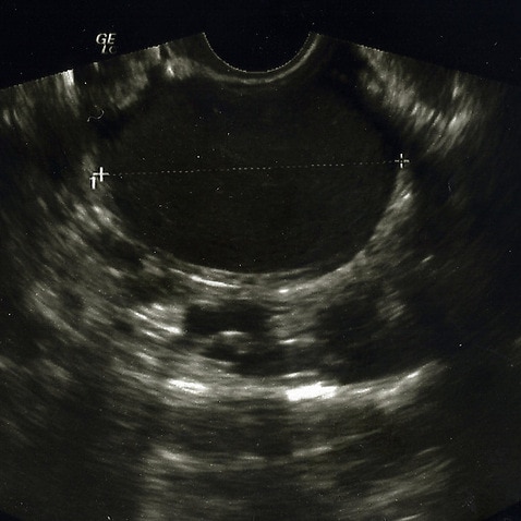 endometriosis cyst ultrasound scan