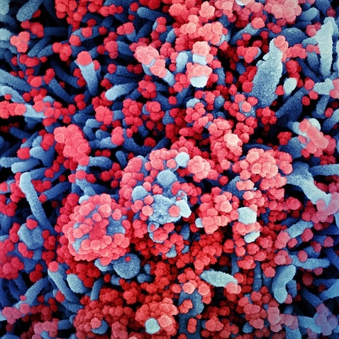 Colourised scanning electron micrograph of a cell (blue) heavily infected with coronavirus particles (red) 