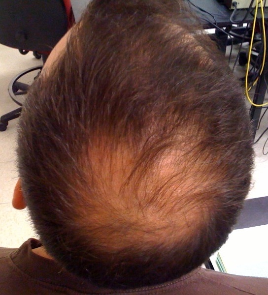 Apolecia is a condition that affects a person’s auto-immune system and causes hair loss to the scalp and body.