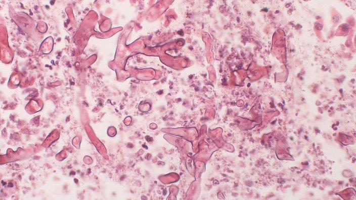 Zygomycosis/ mucormycosis under microscope.