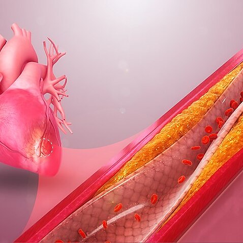 Cornary Artery Disease 