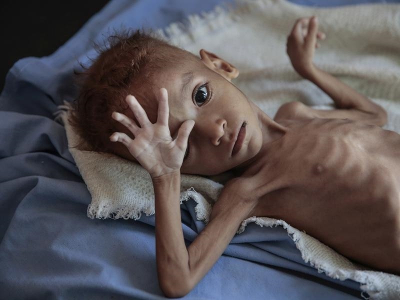 More than 80,000 children in Yemen have died from starvation, charity Save the Children says. A severely malnourished boy in a hospital in Yemen