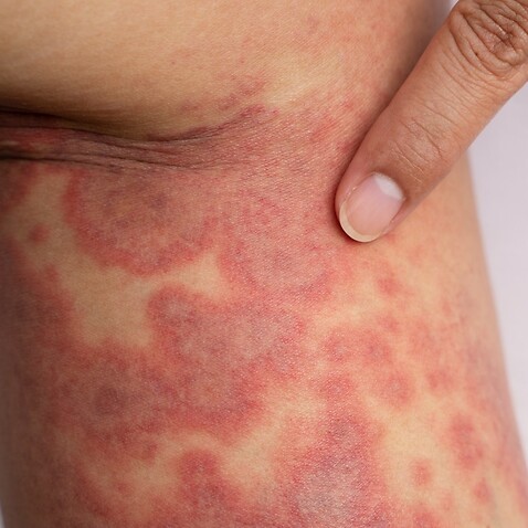 Acute atopic dermatitis