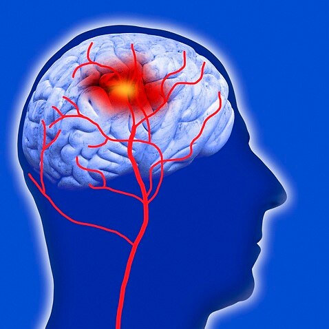 Human brain showing stroke