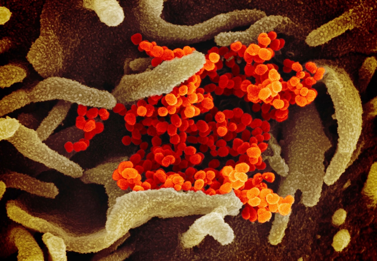 Scanning electron microscope image shows SARS-CoV-2 (orange)also known as 2019-nCoV, emerging from the surface of cells (green).