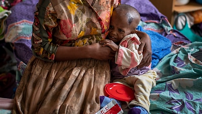 Tekien Tadeseholds her baby, Amanuel Mulu, who is 22 months old and suffering from malnutrition, at Ayder Referral Hospital in the Tigray region of Ethiopia.