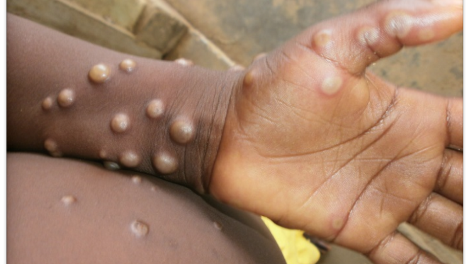 Monkeypox is mainly spread by wild animals. 
