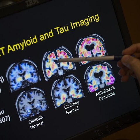 PET scan results that are part of a study on Alzheimer's disease