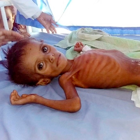 11 million children in Yemen desperately need aid: UN | SBS News